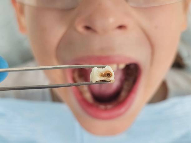 Best Emergency Dental Extractions in Inola, OK